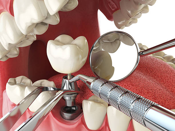 Best Emergency Dental Care for Broken or Chipped Teeth in La Quinta, CA